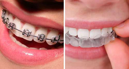 Braces and alignersfor tooth in Mayur Vihar by A&M dental station