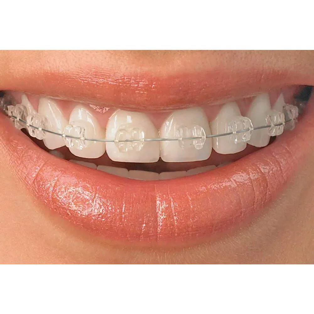 Ceramic Braces