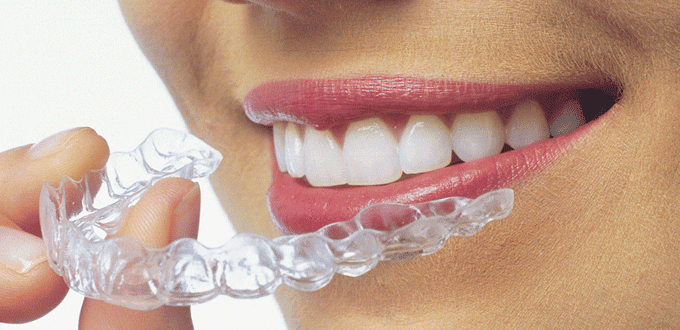 Clear Aligners