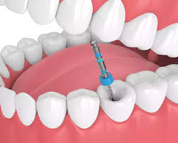 Dental fillings in Mayur Vihar by A&M dental station