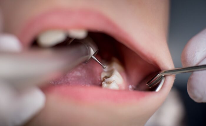 Dental fillings without sensitivity by A&M Dental station