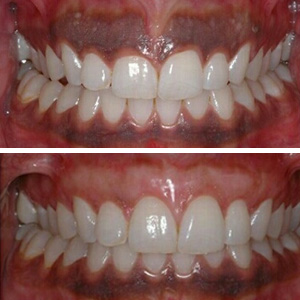 Gum depigmentation by A&M Dental Station
