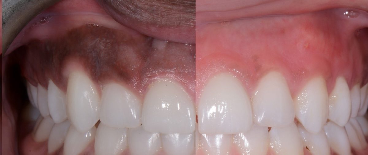 Gum depigmentation by Dr. Avneesh kr. Sharma