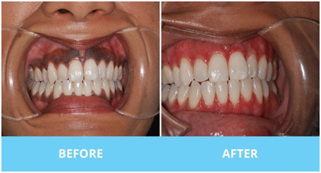 Gum depigmentation in Noida, Sector 70