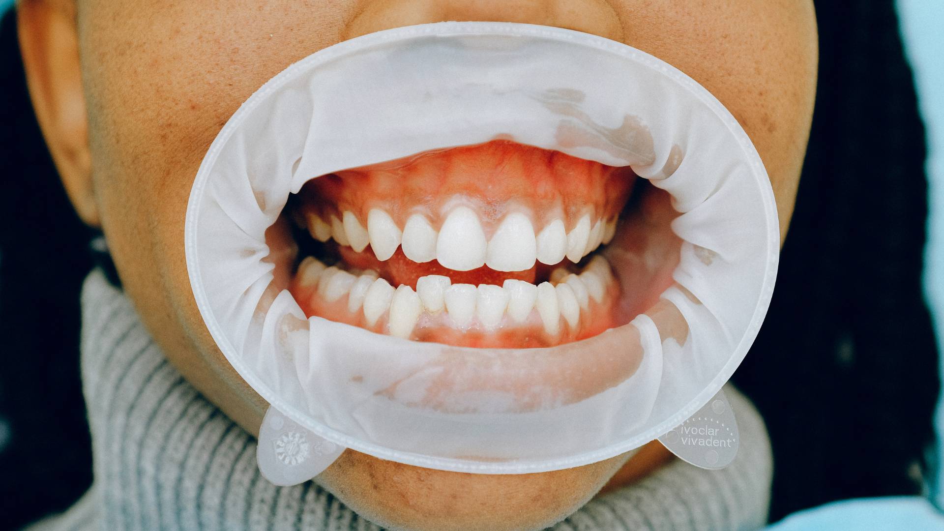 Gum depigmentation in Noida, Sector 70