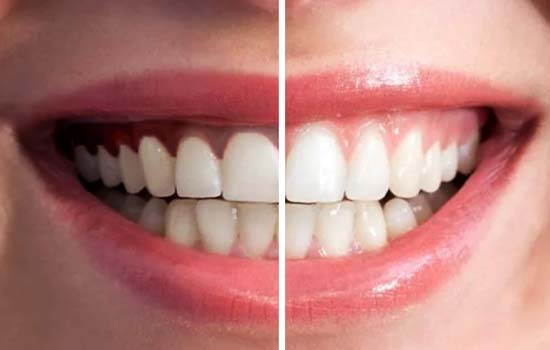 Gum de pigmentation in Mayur Vihar by A&M dental station