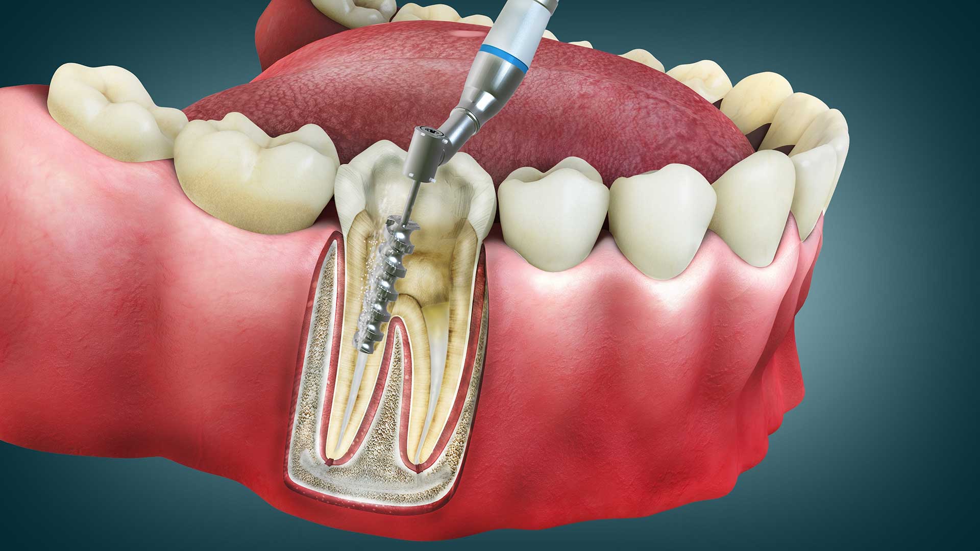 Painless RCT Treatment by A&M Dental Station
