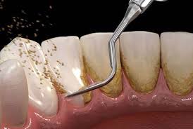 Scaling and Polishing by A&M Dental Station