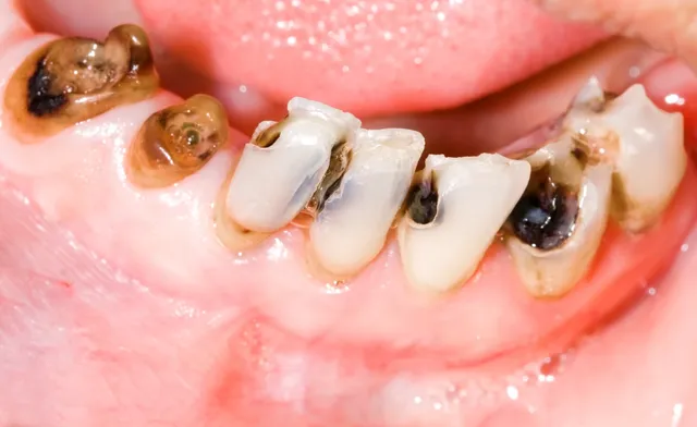 Tooth Cavity and Decay Tooth Treatment by A&M dental Station