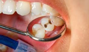 Treatment for cavity and decay problem in Mayur Vihar by A&M dental station