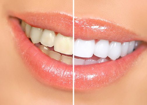 TeethWhitening by A&M Dental Station