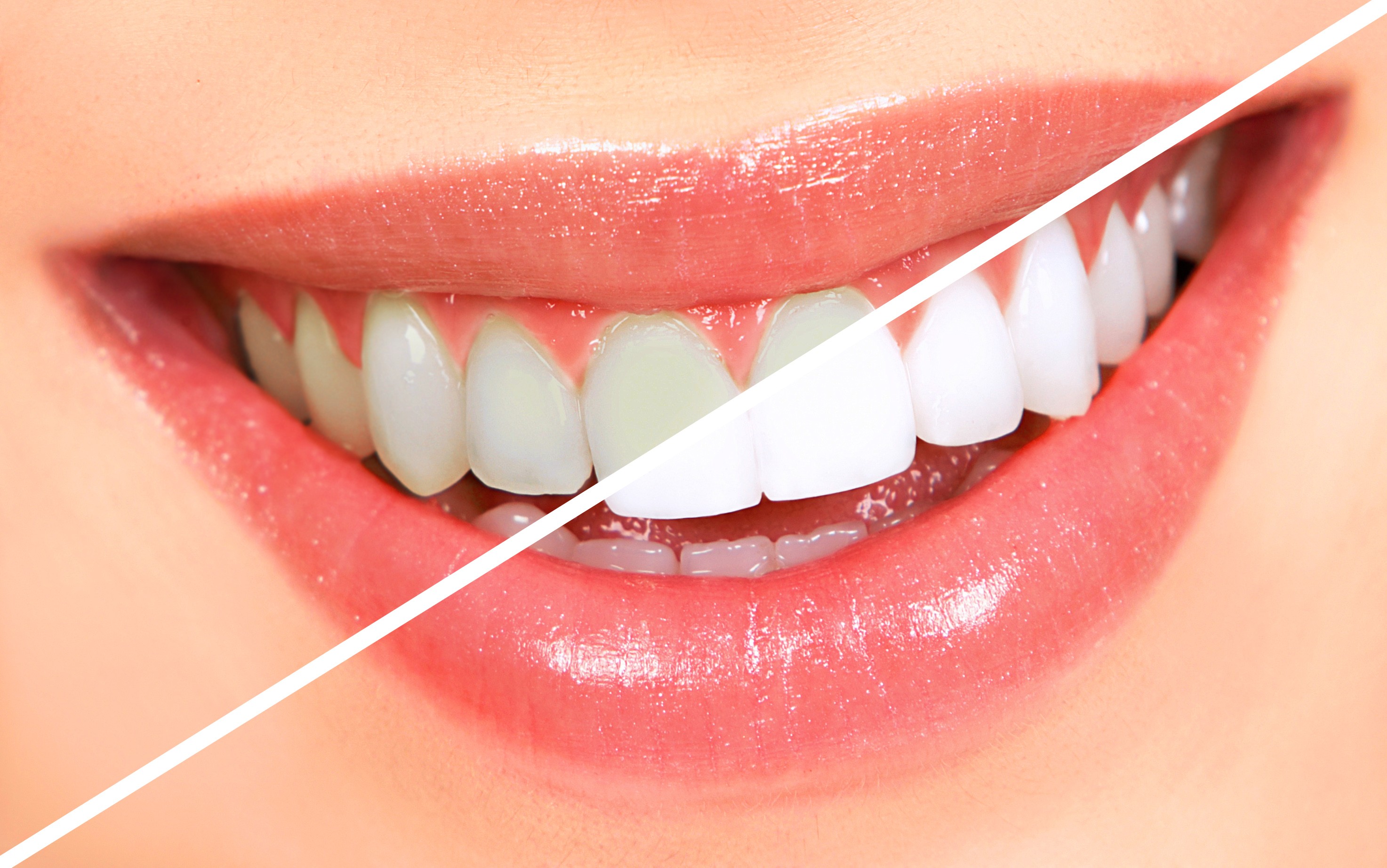 TeethWhitening by Dr. Avneesh kr. Sharma