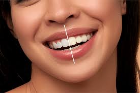 TeethWhitening in Noida, Sector 70