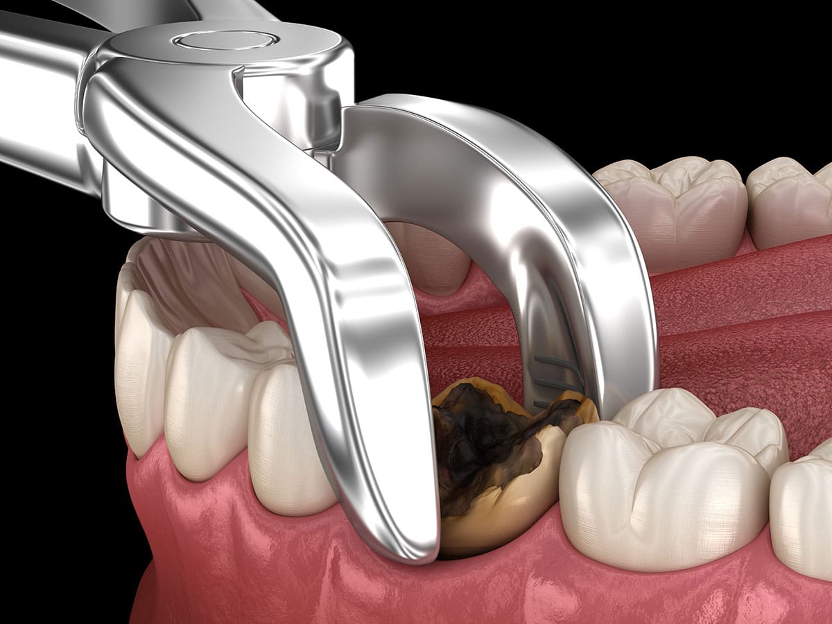 Wisdom Tooth Removal by A&M Dental Station.
