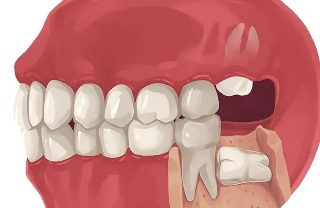 Wisdom Tooth Removal by Dr. Avneesh kr. Sharma