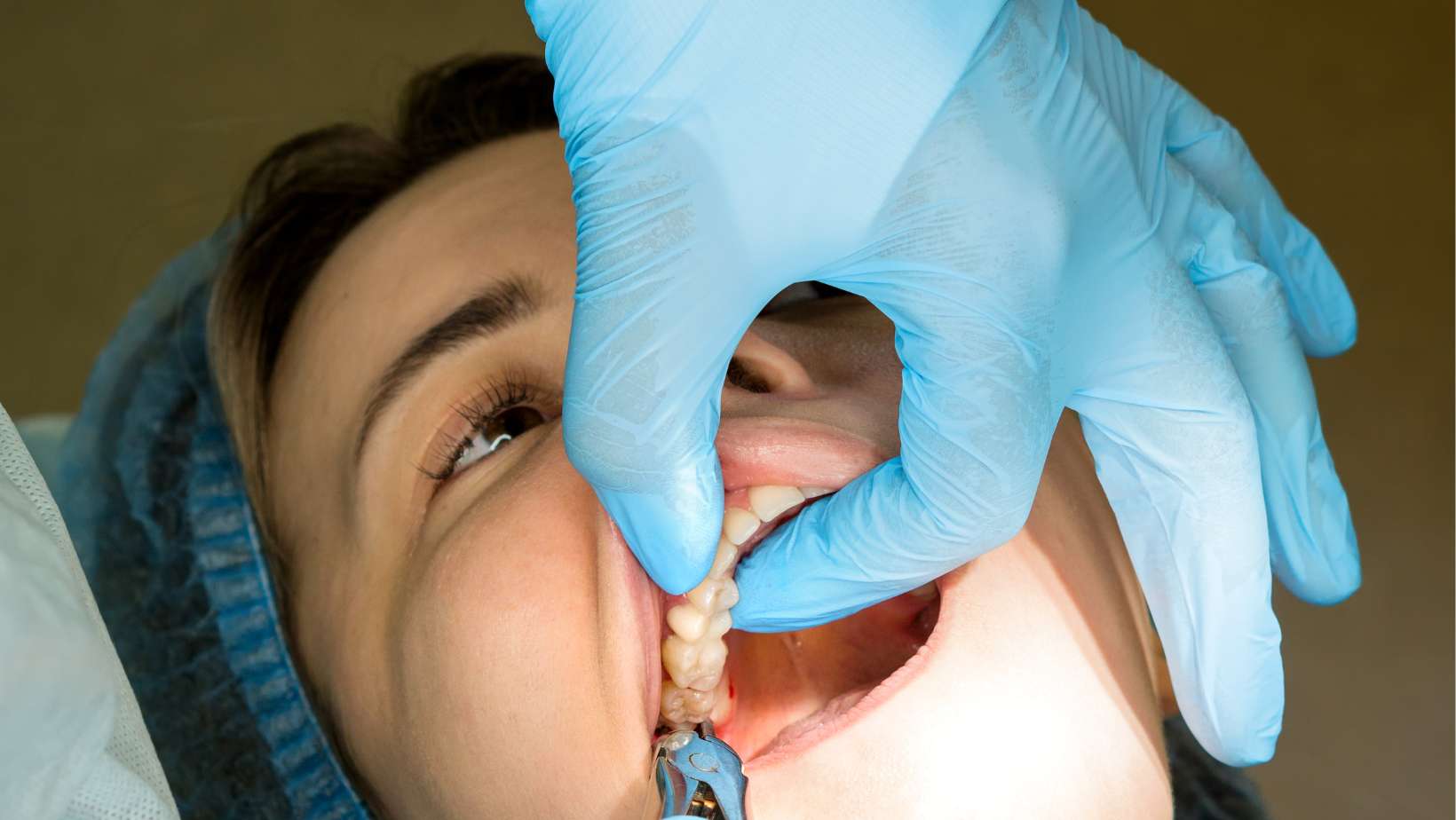 Wisdom Tooth Removal in Noida, Sector 70