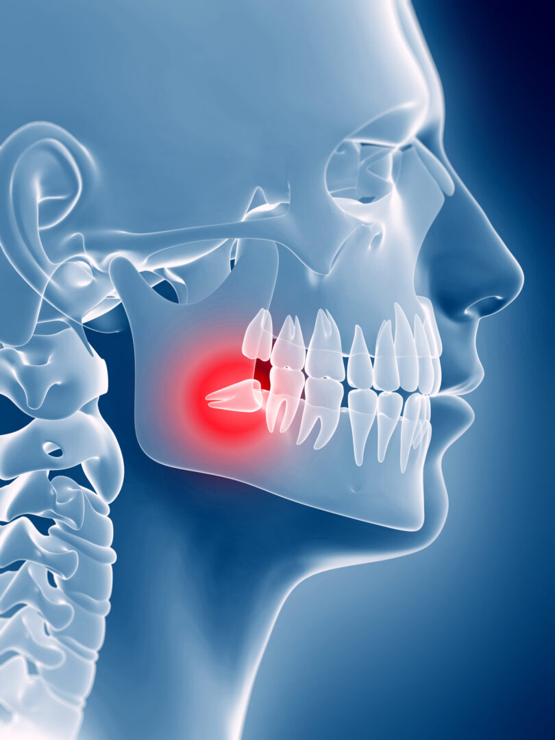 Wisdom Tooth Removal in Mayur Vihar