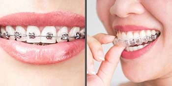 Braces vs. Clear Aligners: Which Smile Solution Fits Your Lifestyle?